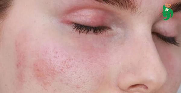 Da nhạy cảm là gì? Vì sao lại “khó chăm sóc”?