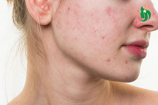 Rối loạn nội tiết tố ảnh hưởng gì đến làn da?