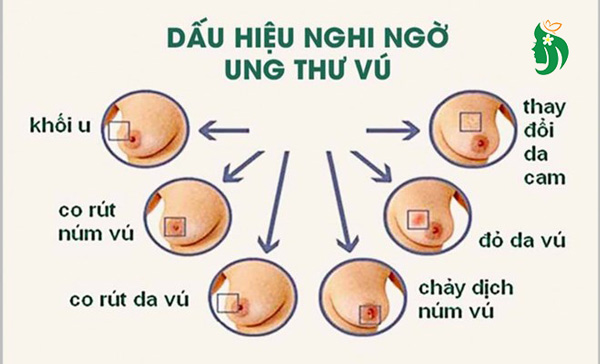 Dấu hiệu nghi ngờ khối u ở vú là ung thư