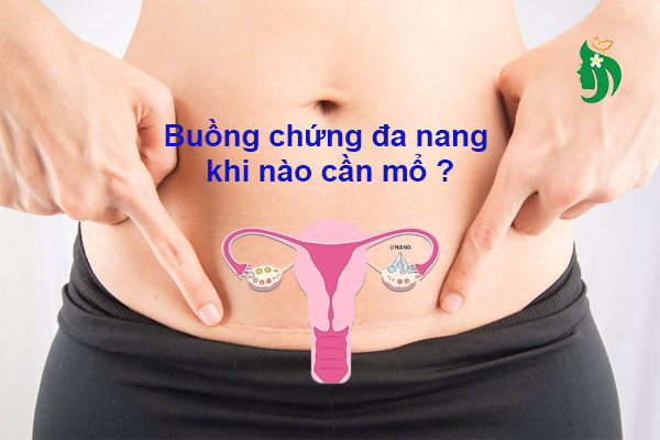 Buồng trứng đa nang có cần mổ không? Khi nào phải phẫu thuật