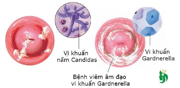 Các dạng viêm âm đạo phổ biến