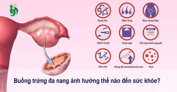 Buồng trứng đa nang ảnh hưởng thế nào đến sức khỏe