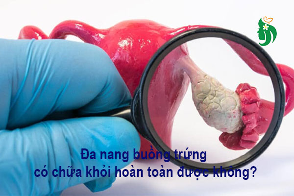Đa nang buồng trứng có chữa khỏi hoàn toàn được không?