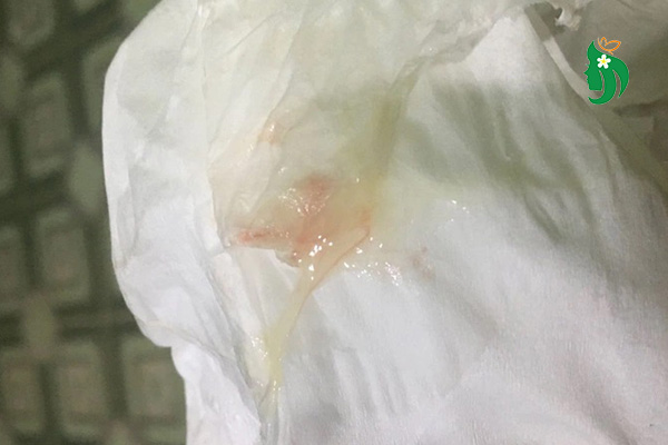 Khí hư có máu lẫn bên trong có nguy hiểm không?