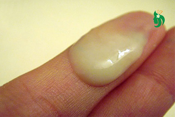 Khí hư có màu vàng xanh là dấu hiệu bệnh gì?