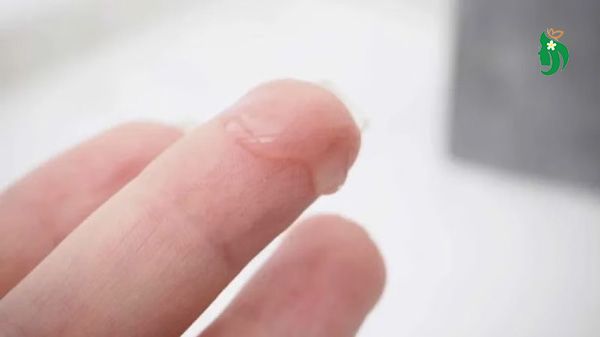Khí hư loãng như nước là bệnh gì, có sao không?