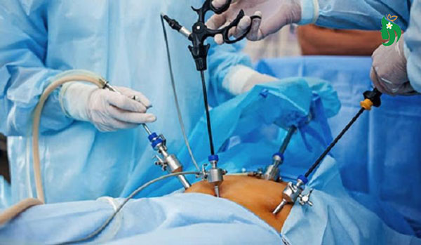 Phẫu thuật buồng trứng đa nang và những điều chị em nên biết