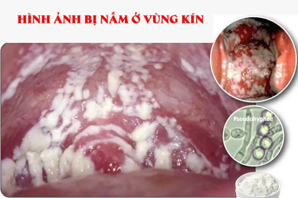 Nấm vùng kín có nguy hiểm không?