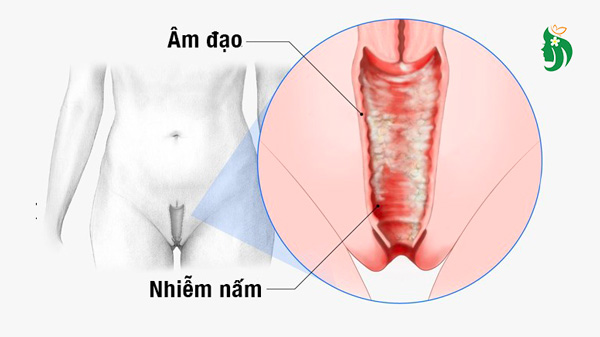Bị nấm ở vùng kín nữ