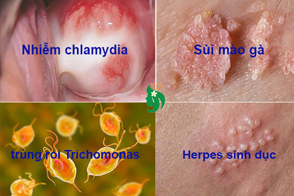 Nguyên nhân khí hư bất thường có khả năng lây truyền