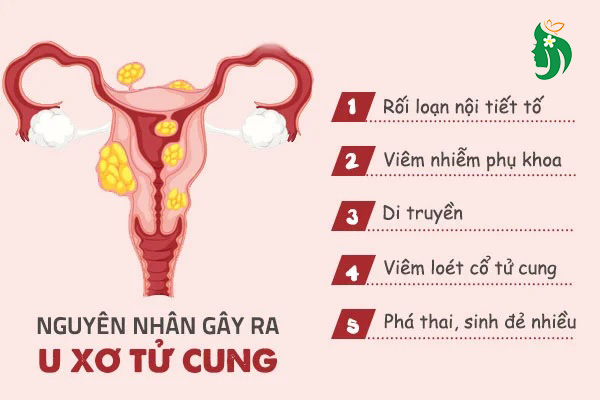 Nguyên nhân hình thành u xơ tử cung