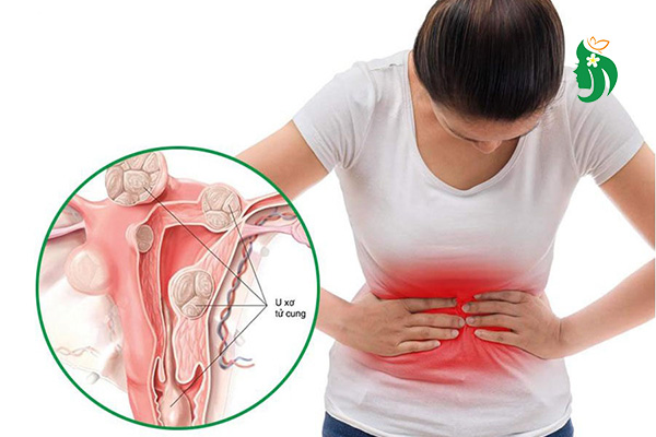 Phụ nữ bao nhiêu tuổi dễ bị u xơ tử cung? Có di truyền không?