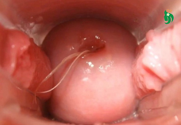 Viêm lộ tuyến cổ tử cung và sự cần thiết của điều trị đúng cách