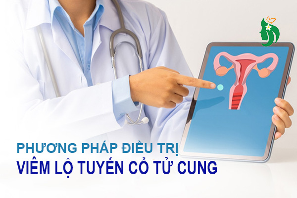 Phương pháp điều trị viêm lộ tuyến cổ tử cung hiệu quả