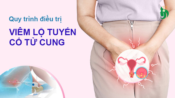 Các bước điều trị viêm lộ tuyến cổ tử cung