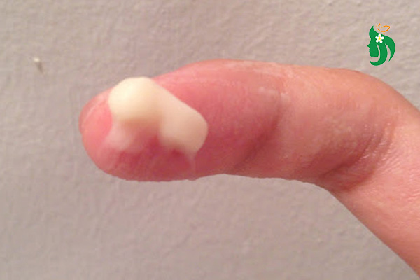 Ra nhiều khí hư màu trắng đục có nguy hiểm không?