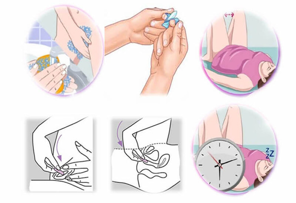 Thuốc đặt điều trị viêm cổ tử cung