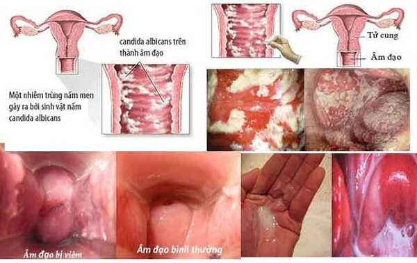 bệnh phụ khoa thường gặp ở nữ giới