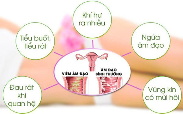 Vì sao dễ nhầm lẫn giữa viêm âm đạo và bệnh phụ khoa khác?