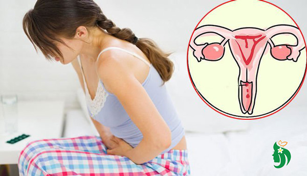 Hiểu về viêm cổ tử cung để không mắc phải sai lầm đáng tiếc