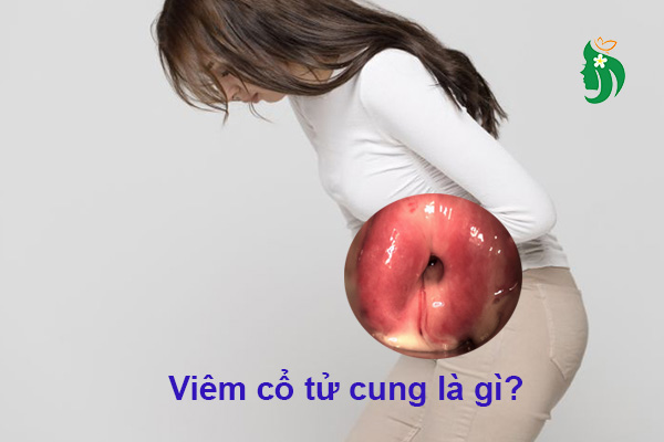 Viêm cổ tử cung là gì? Nguyên nhân, triệu chứng và cách điều trị hiệu quả